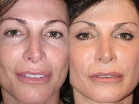 antes e depois do rejuvenescimento da pele por plasma