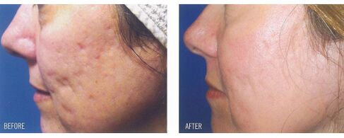Antes e depois de aplicar o dispositivo a laser na pele com cicatrizes