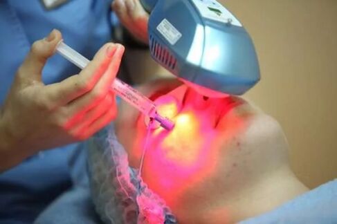 Biorevitalização a laser da pele facial