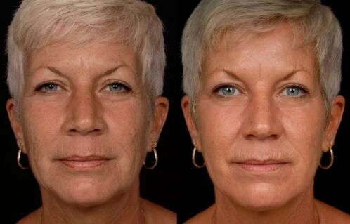 O resultado do tratamento a laser da pele facial - redução das rugas