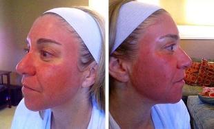 Vermelhidão facial após rejuvenescimento a laser