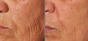 foto antes e depois do rejuvenescimento fracionário da pele