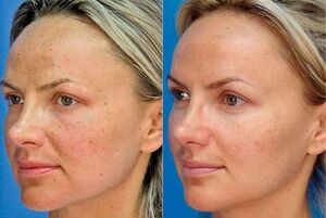 foto antes e depois do rejuvenescimento da pele com o dispositivo